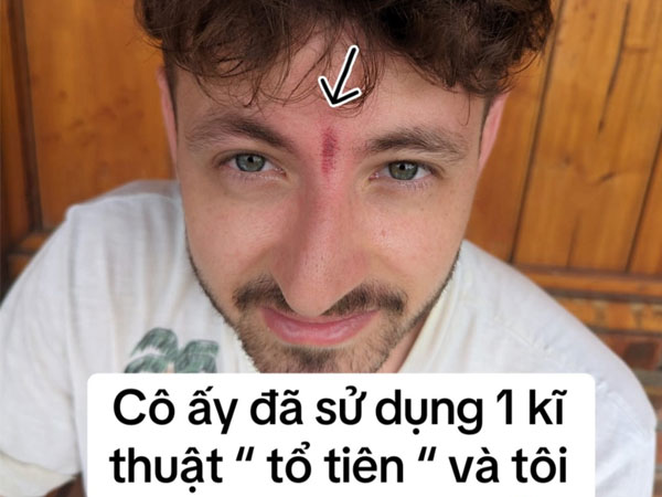 Khách Tây bất ngờ bị 'phong ấn' trên trán vì trót than đau đầu khi tới Việt Nam