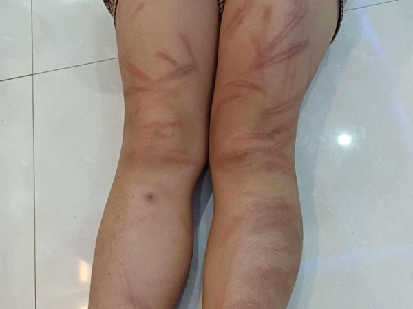 Vụ nhiều học sinh mầm non bị đánh bầm tím: Đánh các bạn là bé gái 5 tuổi