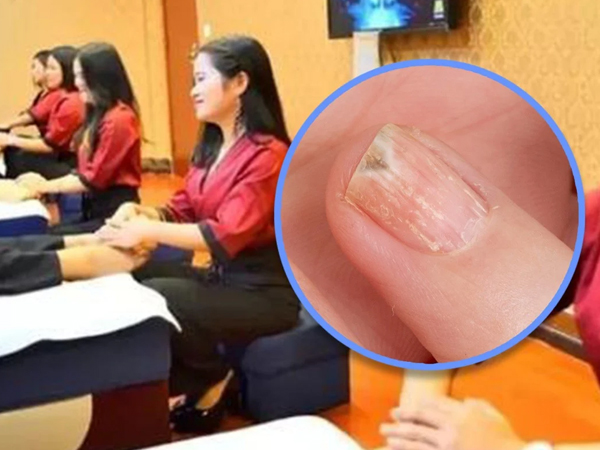 Bé trai phải cắt bỏ ngón tay sau khi bố đưa đến tiệm nail để chữa nấm móng tay