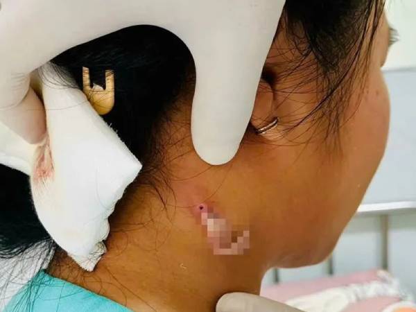 TPHCM: Phát hiện ca bệnh nhiễm 'vi khuẩn ăn thịt người'