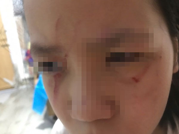 Ba giáo viên ở Hà Nội bị kỷ luật vì để nữ sinh lớp 5 bị bạn đánh rách mặt trong lớp học