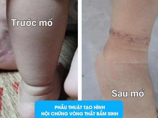 Phú Thọ: Bé gái 16 tháng tuổi có ngấn trên chân, bố mẹ tưởng bụ bẫm nhưng hoá ra lại là dị tật bẩm sinh nguy hiểm