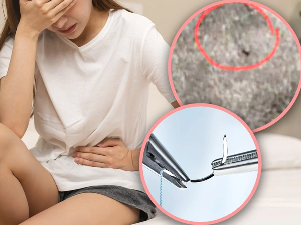 Phát hiện kim khâu vẫn còn trong 'vùng kín' sau 18 năm chịu những cơn đau hành hạ