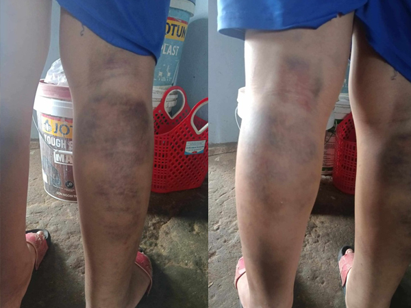 Tạm đình chỉ giáo viên đánh học sinh bầm tím 2 chân