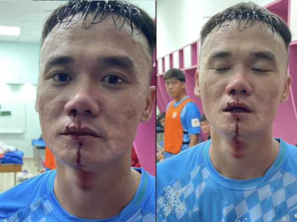 Xuân Nam và Văn Sơn nhận án nặng vì đánh nhau đổ máu