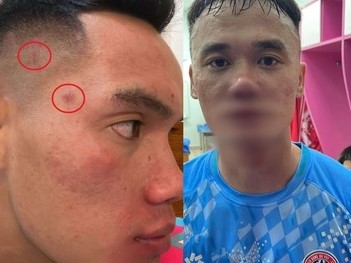 Vụ ẩu đả gây tranh cãi làng bóng Việt: Cầu thủ đấm Xuân Nam hé lộ ảnh thương tích, tố bị đập giày vào đầu