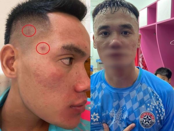Cầu thủ hạng Nhất không xin lỗi Xuân Nam sau vụ ẩu đả, CLB tính kháng cáo án phạt của VFF