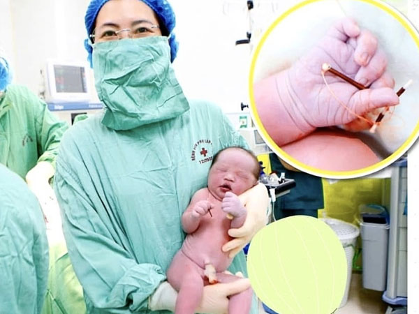 Hy hữu: Bé trai chào đời cùng vòng tránh thai của mẹ