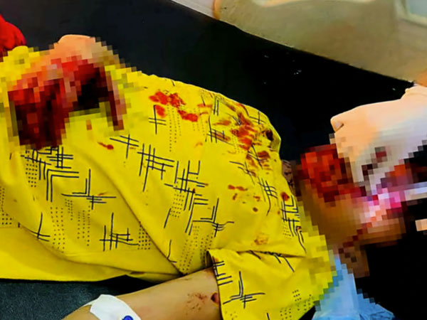 Dập nát bàn tay, vùng mặt do điện thoại phát nổ khi sạc