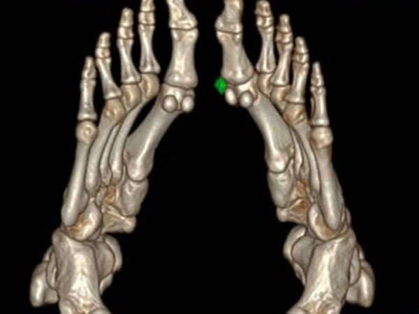 Bất ngờ nam sinh 17 tuổi ở Hà Nội mắc bệnh gút suốt 2 năm mà không hề hay biết