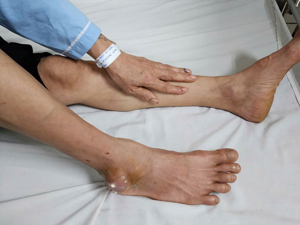 Ăn Tết vô độ, người đàn ông Hà Nội cấp cứu trong tình trạng đau đớn