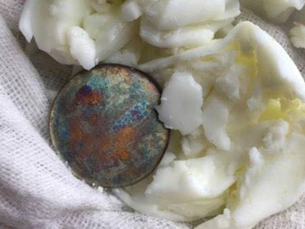 Vì sao đánh gió phải dùng đồ bạc mà không phải kim loại khác?