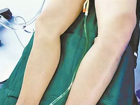 Bác sĩ lấy ra cục máu đông 'dài nửa mét' từ chân trái của chàng trai 22 tuổi, nguyên nhân do thói quen ban đêm của nhiều người