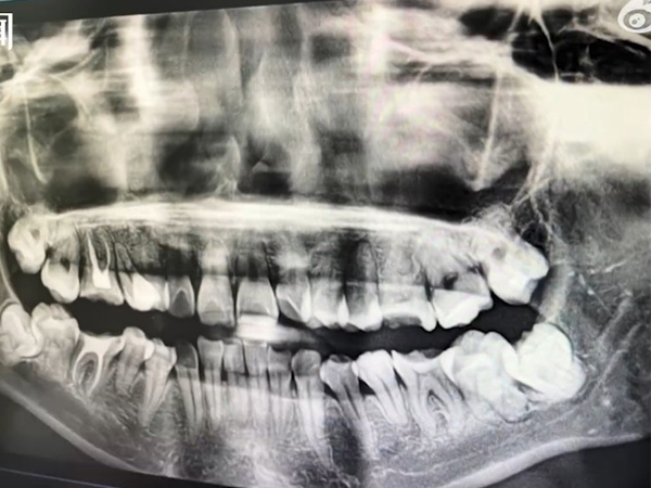 Đi nhổ răng khôn bị bác sĩ nhổ nhầm răng thật, người phụ nữ có lựa chọn tiêu cực
