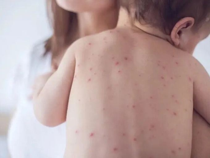 Bé gái gần 4 tuổi ở Hà Nội tử vong do mắc sởi