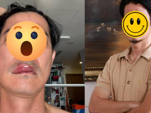 Sao nam Vbiz phát hoảng vì mặt biến dạng, sưng phồng bất thường