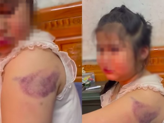 Clip 32 giây vụ học sinh lớp 1 nghi bị cô giáo đánh bầm tím tay vì viết chữ xấu