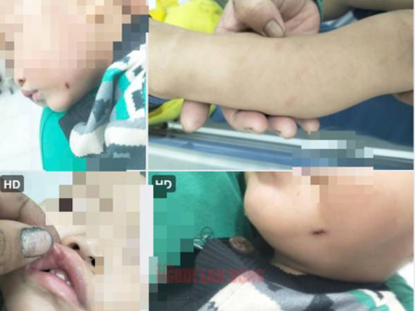 Nữ giáo viên đánh trẻ dã man: Kết quả điều tra ban đầu từ Công an Quảng Nam