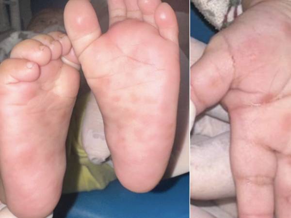 Bé trai 4 tháng bất ngờ được phát hiện mắc giang mai, dấu hiệu nào chỉ điểm?