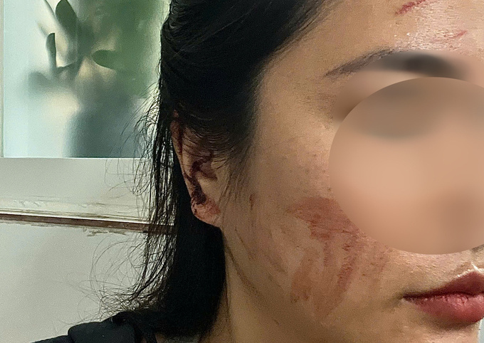 Kết quả giám định vụ cô gái cầu cứu sau khi bị bạn cùng phòng trọ hành hung rách tai vì lấy nhầm nồi nấu ăn