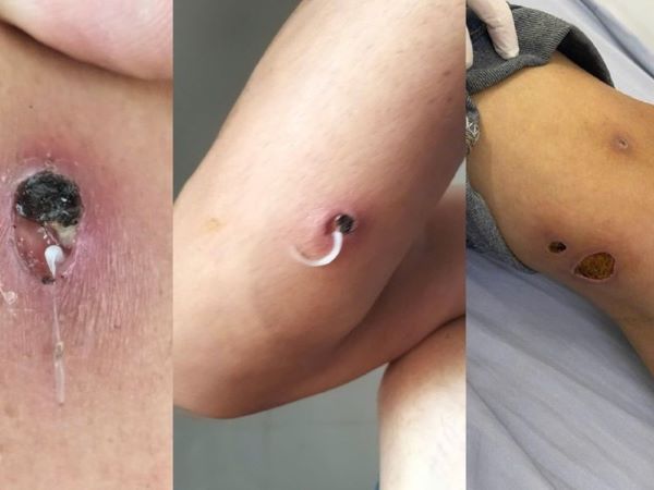 Cảnh báo bệnh giun rồng xuất hiện tại một tỉnh ở Việt Nam