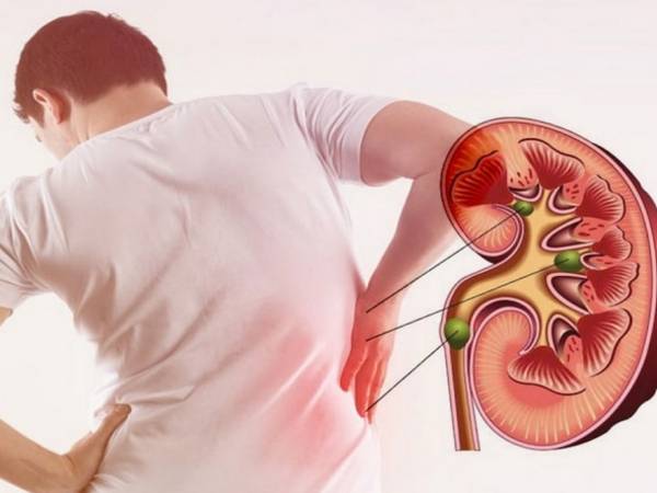 Sỏi tiết niệu: Kẻ thù thầm lặng của hệ tiết niệu