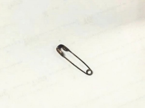 Nội soi lấy kim băng khỏi thực quản bé 5 tháng tuổi