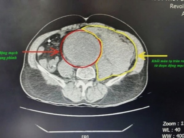Cứu sống người đàn ông đột ngột đau bụng dữ dội, mất 2 lít máu do vỡ phình động mạch chủ bụng