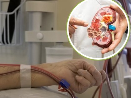 Người trẻ bị suy thận ngày càng cao: 'Nằm lòng' 3 lời khuyên từ bác sĩ để dự phòng sớm căn bệnh này!