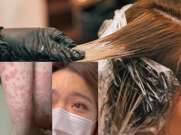 Nữ sinh 20 tuổi trả giá đắt vì đam mê nhuộm tóc: Thận xuất huyết, phải cạo trọc đầu giữ mạng