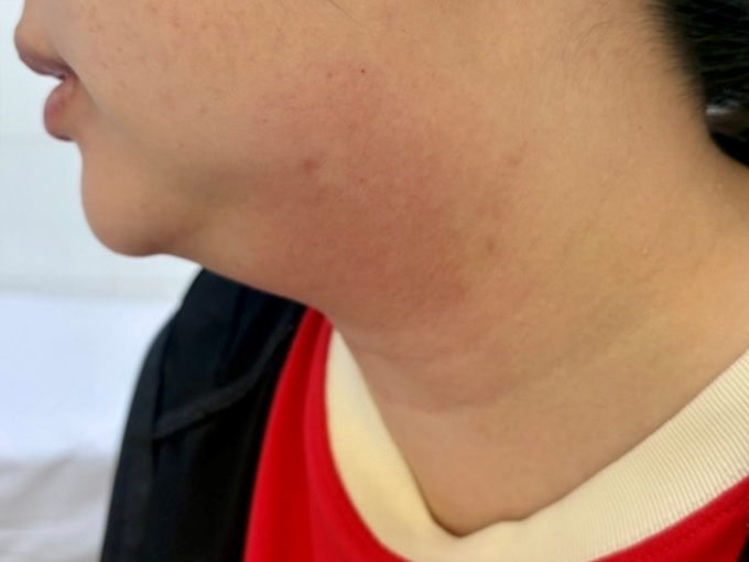 Người phụ nữ 33 tuổi ở miền Tây suýt trả giá đắt vì muốn tan mỡ