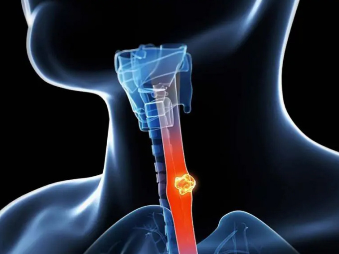 Thói quen ăn uống tưởng chừng vô hại âm thầm phá hủy tế bào, gia tăng nguy cơ ung thư thực quản