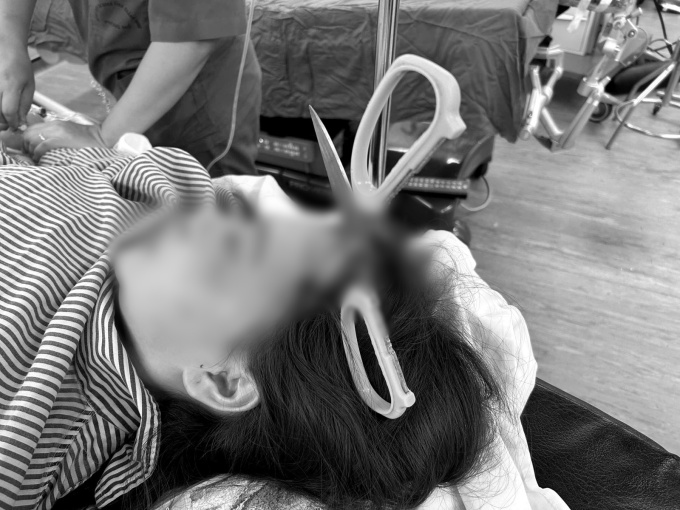 Kinh hãi cô gái 25 tuổi ở Quảng Ninh nhập viện với chiếc kéo sắc nhọn đâm xuyên sọ não