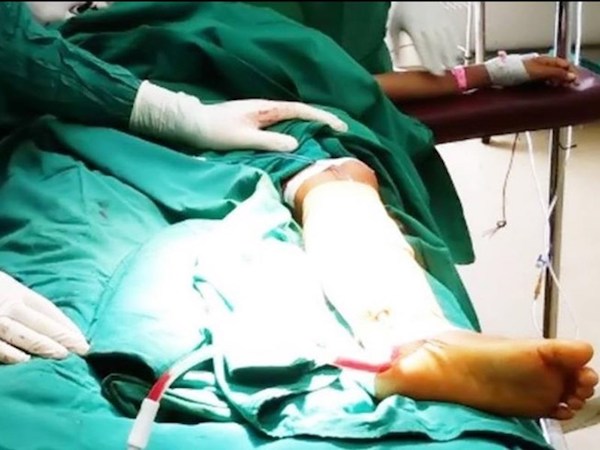 Con suýt mất chân vì cha mẹ mời 'thầy' cắt lễ