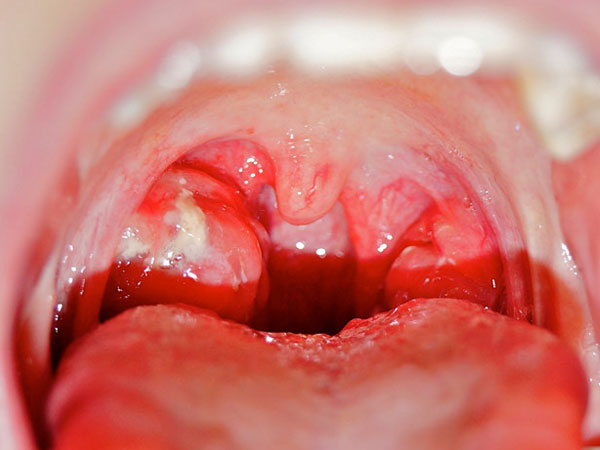 Dấu hiệu không được chủ quan khi trẻ bị viêm mũi họng