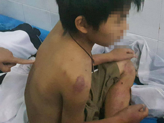 Cậu bé 11 tuổi nghi bị bố đánh đa chấn thương