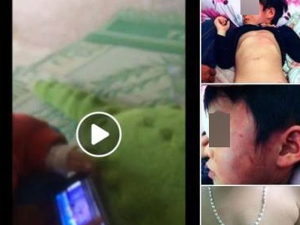 Bắc Giang: Gia đình tố cô giáo đánh con bầm tím toàn thân khi đi học ở trường