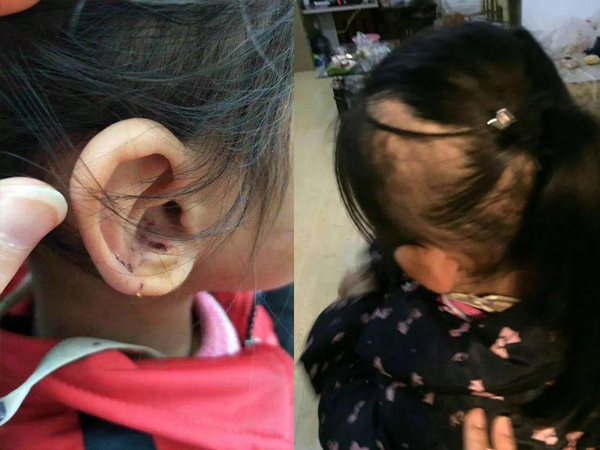 Bé gái 6 tuổi bị mẹ đẻ ngược đãi dã man khiến mặt đầy vết thương, tóc rụng thành mảng lớn