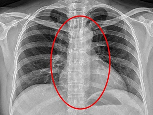 Gái bán dâm nuốt... bao cao su của khách để giấu bằng chứng khi bị cảnh sát bắt