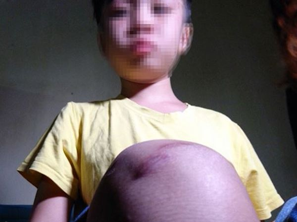 Mẹ kế bạo hành bé 10 tuổi ra công an trình diện