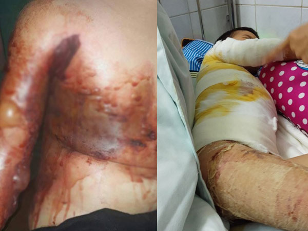 Nghịch dại bé 5 tuổi bỏng nặng, mẹ thiếu tiền đành cho con xuất viện sớm để dùng thuốc nam khiến con bị hoại tử