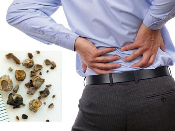 Những ai có nguy cơ mắc sỏi thận?