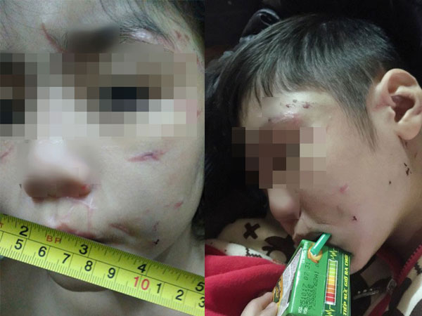 Bác sĩ tâm lý 'mổ xẻ' vụ bố, mẹ kế bạo hành bé trai 10 tuổi