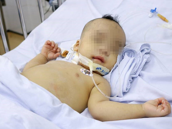 TP.HCM: Bé trai 1 tuổi sốc nhiễm trùng nặng, tiên lượng tử vong 99% được cứu sống