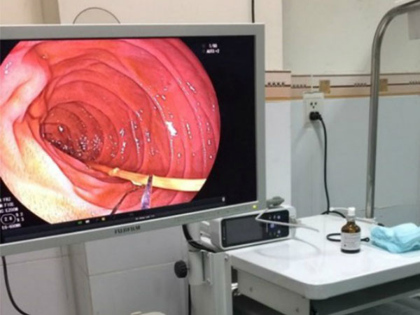 6 cây nhang cháy dở nằm trong ruột người đàn ông