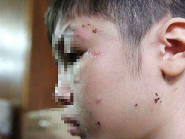 Đề nghị khởi tố vụ bé trai 10 tuổi bị mẹ kế bạo hành ở Hà Nội