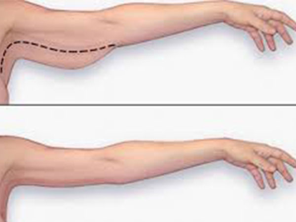 4 động tác đánh tan mỡ thừa vùng bắp tay trong 3 phút