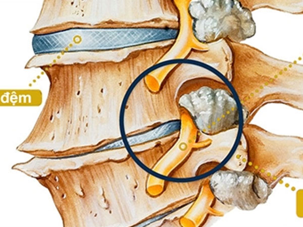 Nhận biết dấu hiệu thoái hóa cột sống