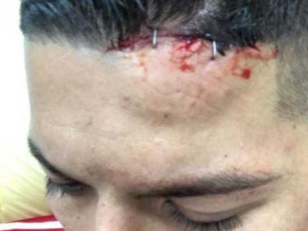 Rojo 'khoe' chấn thương ghê rợn sau trận gặp Man City