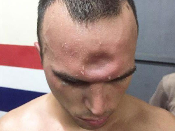 SỐC: Võ sĩ Muay Thái lõm trán kinh hoàng sau cú thúc chỏ của đối thủ